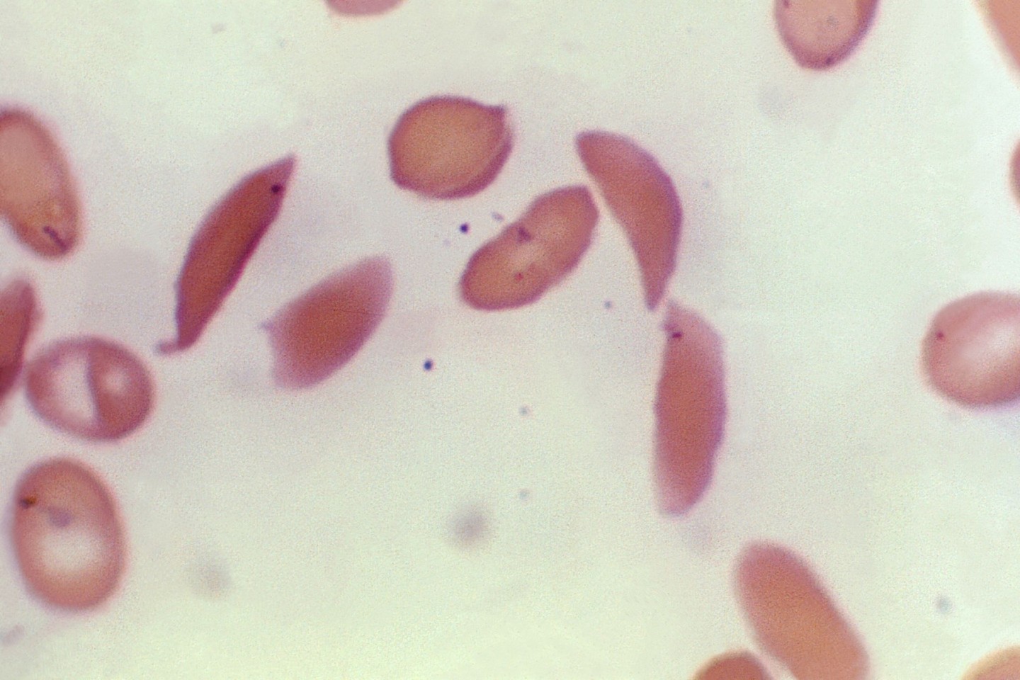 Mikroskopbild zeigt halbmondförmige rote Blutkörperchen eines an Sichelzellenanämie erkrankten Patienten aus dem Jahr 1972.