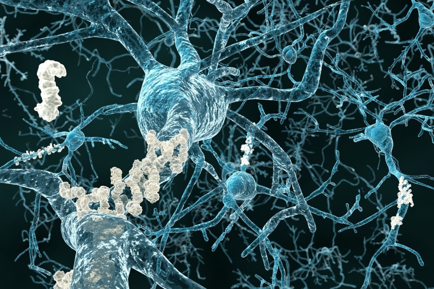 Eiweißablagerungen zwischen den Nervenzellen (Plaques) sind zum Teil ursächlich für Alzheimer-Symptome.